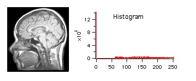 histogram equalization of std. MRI image